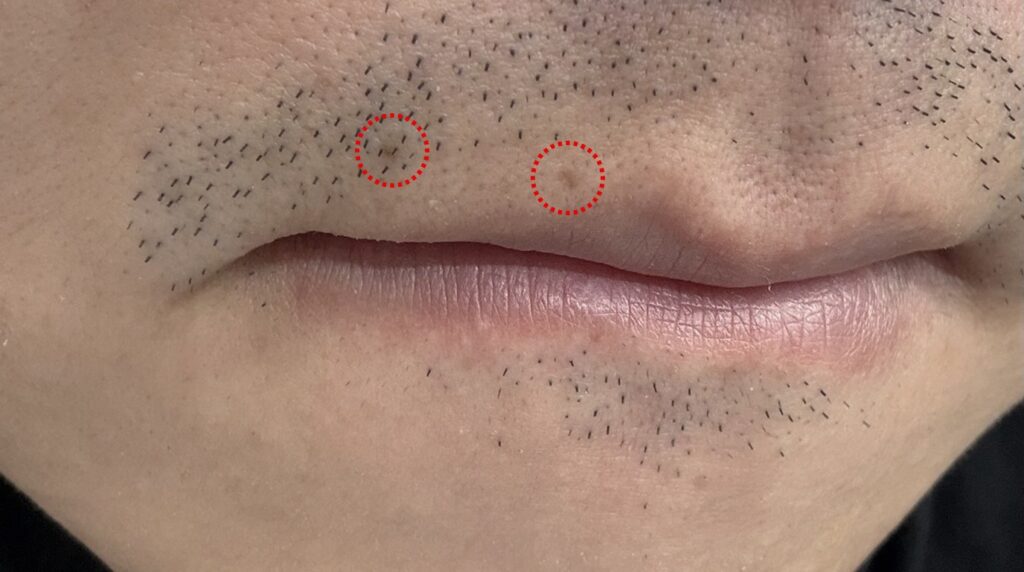 면도하다 생긴 상처 때문에 생긴 색소 침착..어떻게 없앨까요?